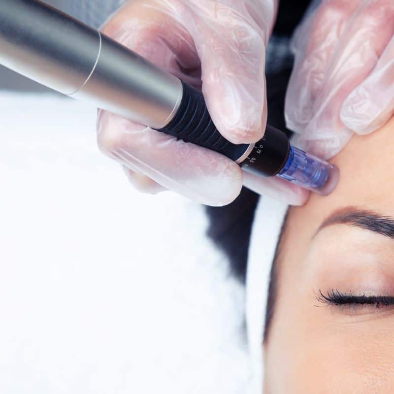 Morpheus8 treatment Arundel from Lipo Sculpt - Book in today!